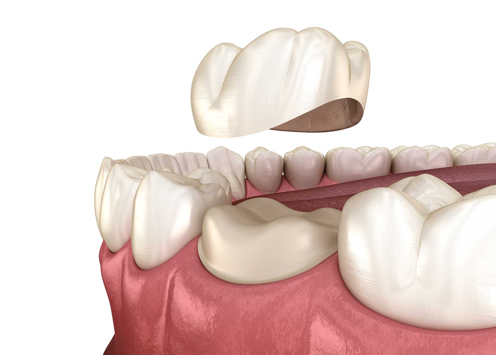 Couronne dentaire (CEREC) et pont dentaire
